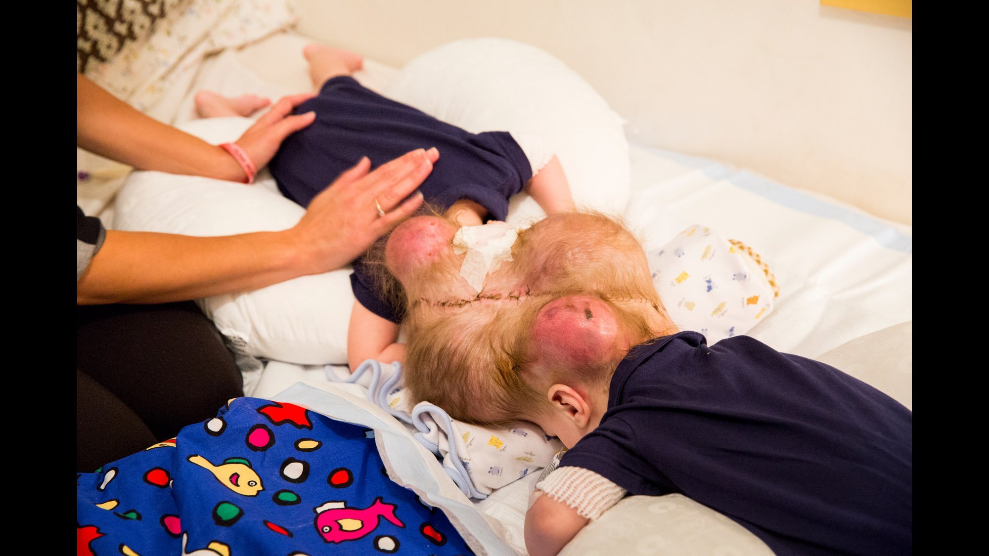 Anias and Jadon McDonald are twins conjoined at the head. Their birth was rare; science says the boys are one in millions. At 13 months old they are undergoing separation surgery