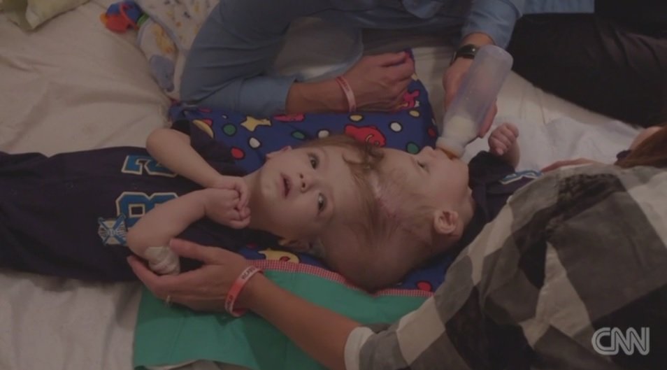 Anias and Jadon McDonald are twins conjoined at the head. Their birth was rare; science says the boys are one in millions. At 13 months old they are undergoing separation surgery